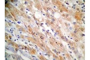 Human hepatocellular carcinoma tissue was stained by Rabbit Anti-FGF-21 (26-47) (H) Antibody (FGF21 antibody  (AA 26-47))