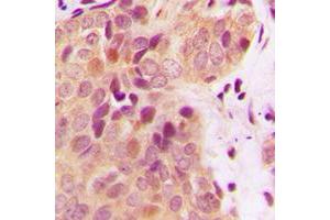 Immunohistochemical analysis of BRCA2 staining in human breast cancer formalin fixed paraffin embedded tissue section. (BRCA2 antibody  (N-Term))