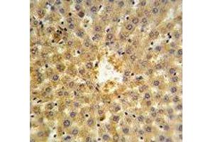 Annexin V antibody IHC analysis in formalin fixed and paraffin embedded human hepatocarcinoma. (Annexin V antibody  (AA 1-30))