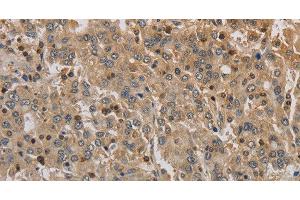 Immunohistochemistry of paraffin-embedded Human liver cancer using ADO Polyclonal Antibody at dilution of 1:30 (ADO antibody)