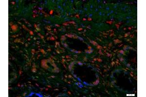Formalin-fixed and paraffin embedded human colon carcinoma labeled with Anti-SAMDC/AMD1 Polyclonal Antibody, Unconjugated (ABIN735893) at 1:200. (AMD1 antibody  (AA 51-150))