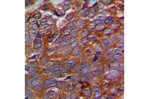 Immunohistochemical analysis of p311 staining in human prostate cancer formalin fixed paraffin embedded tissue section. (NREP antibody  (Center))