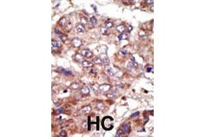 Formalin-fixed and paraffin-embedded human cancer tissue reacted with the primary antibody, which was peroxidase-conjugated to the secondary antibody, followed by AEC staining. (ACSL6 antibody  (AA 240-270))