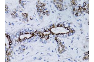Immunohistochemistry of paraffin-embedded human breast cancer using BRCA1 antibody. (BRCA1 antibody)