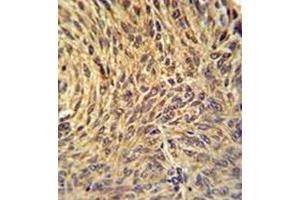 Immunohistochemistry analysis in formalin fixed and paraffin embedded human lung carcinoma reacted with NUP210 / GP210 Antibody (N-term) followed by peroxidase conjugation of the secondary antibody and DAB staining. (NUP210 antibody  (N-Term))