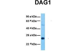 Host:  Rabbit  Target Name:  DAG1  Sample Tissue:  Human Stomach Tumor  Antibody Dilution:  1. (Dystroglycan antibody  (Middle Region))