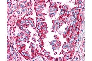 Anti-WNT5B antibody IHC of human Lung, Non-Small Cell Carcinoma. (WNT5B antibody  (Internal Region))