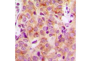 Immunohistochemical analysis of HGS staining in human breast cancer formalin fixed paraffin embedded tissue section. (HGS antibody  (Center))