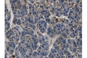 Detection of RNASE3 in Human Pancreatic cancer Tissue using Monoclonal Antibody to Ribonuclease A3 (RNASE3) (RNASE3 antibody  (AA 30-154))