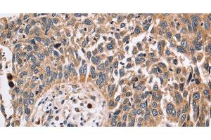 Immunohistochemistry of paraffin-embedded Human lung cancer using FUCA1 Polyclonal Antibody at dilution of 1:30 (FUCA1 antibody)