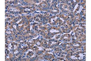 The image on the left is immunohistochemistry of paraffin-embedded Human thyroid cancer tissue using ABIN7191187(KCNJ9 Antibody) at dilution 1/30, on the right is treated with synthetic peptide. (KCNJ9 antibody)