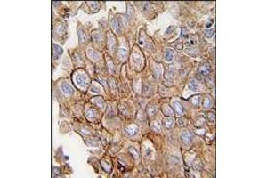 Formalin-fixed and paraffin-embedded human lung carcinoma tissue reacted with ANXA2 antibody (C-term), which was peroxidase-conjugated to the secondary antibody, followed by DAB staining. (Annexin A2 antibody  (C-Term))