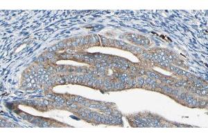 ABIN6278876 at 1/100 staining Human cervical cancer tissue by IHC-P. (IFIT2 antibody  (Internal Region))