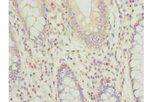Immunohistochemistry of paraffin-embedded human colon cancer using ABIN7167582 at dilution of 1:100 (RPRD1B antibody  (AA 2-172))