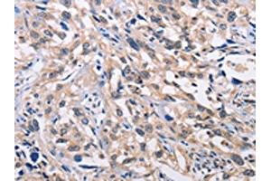The image on the left is immunohistochemistry of paraffin-embedded Human esophagus cancer tissue using ABIN7128359(ALG8 Antibody) at dilution 1/30, on the right is treated with fusion protein. (ALG8 antibody)