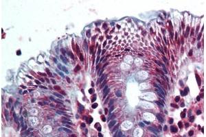 Human Colon (formalin-fixed, paraffin-embedded) stained with AKR1B10 antibody ABIN292629 at 10 ug/ml followed by biotinylated goat anti-rabbit IgG secondary antibody ABIN481713, alkaline phosphatase-streptavidin and chromogen. (AKR1B10 antibody  (AA 100-200))