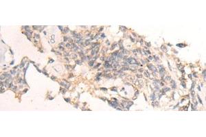 Immunohistochemistry of paraffin-embedded Human ovarian cancer tissue using IBA57 Polyclonal Antibody at dilution of 1:65(x200)