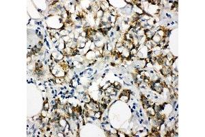 IHC-P: Cytokeratin 8 antibody testing of human breast cancer tissue (KRT8 antibody  (N-Term))