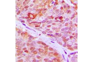 Immunohistochemical analysis of ZNF148 staining in human breast cancer formalin fixed paraffin embedded tissue section. (ZNF148 antibody  (N-Term))