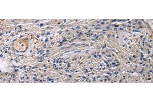 Immunohistochemistry of paraffin-embedded Human brain tissue using SLC30A3 Polyclonal Antibody at dilution of 1:55(x200) (Slc30a3 antibody)