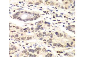 Immunohistochemistry of paraffin-embedded Human colon carcinoma using CCNC Polyclonal Antibody at dilution of 1:100 (40x lens). (Cyclin C antibody)