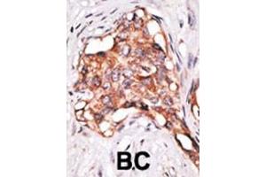 Formalin-fixed and paraffin-embedded human cancer tissue reacted with the primary antibody, which was peroxidase-conjugated to the secondary antibody, followed by DAB staining. (GDF3 antibody  (N-Term))