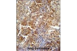 ERCC8 antibody (Center) (ABIN654909 and ABIN2844556) immunohistochemistry analysis in formalin fixed and paraffin embedded human lung carcinoma followed by peroxidase conjugation of the secondary antibody and DAB staining. (ERCC8 antibody  (AA 210-238))