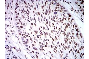 Immunohistochemical analysis of paraffin-embedded esophageal cancer tissues using ZFP91 mouse mAb with DAB staining. (ZFP91 antibody  (AA 162-304))