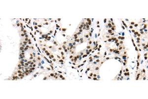 Immunohistochemistry of paraffin-embedded Human thyroid cancer using DDX39B Polyclonal Antibody at dilution of 1/40 (DDX39B antibody)