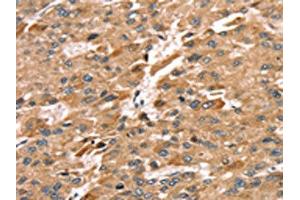 The image on the left is immunohistochemistry of paraffin-embedded Human liver cancer tissue using ABIN7192291(SDC3 Antibody) at dilution 1/30, on the right is treated with synthetic peptide. (SDC3 antibody)