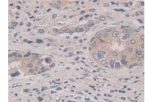 IHC-P analysis of Human Prostate cancer Tissue, with DAB staining. (APLP2 antibody  (AA 607-852))