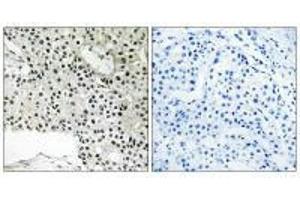 Immunohistochemistry analysis of paraffin-embedded human breast carcinoma tissue using TCEAL4 antibody. (TCEAL4 antibody)