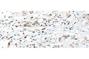 Immunohistochemistry of paraffin-embedded Human gastric cancer tissue using CHRNA5 Polyclonal Antibody at dilution of 1:50(x200) (CHRNA5 antibody)