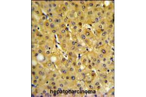 FBP1 Antibody IHC analysis in formalin fixed and paraffin embedded human hepatocarcinoma followed by peroxidase conjugation of the secondary antibody and DAB staining. (FBP1 antibody  (AA 125-156))