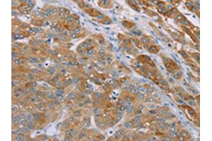 The image on the left is immunohistochemistry of paraffin-embedded Human liver cancer tissue using ABIN7192256(SAMD4A Antibody) at dilution 1/30, on the right is treated with synthetic peptide. (SAMD4A antibody)