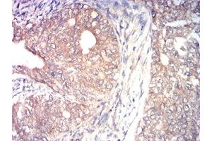 Immunohistochemical analysis of paraffin-embedded cervical cancer tissues using MAP3K14 mouse mAb with DAB staining.
