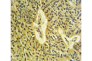 SMAD7 antibody IHC analysis in formalin fixed and paraffin embedded lung carcinoma. (SMAD7 antibody  (AA 195-224))