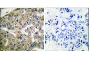 Immunohistochemistry analysis of paraffin-embedded human breast carcinoma tissue, using FHIT Antibody. (FHIT antibody  (AA 81-130))