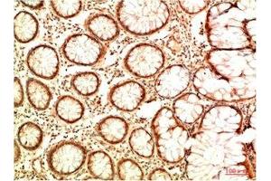 Immunohistochemical analysis of paraffin-embedded Human Colon Carcinoma Tissue using Acetyl P53(K382) Mouse mAb diluted at 1:2000 (p53 antibody  (acLys382))