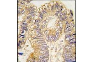 Formalin-fixed and paraffin-embedded human colon carcinoma tissue reacted with CLIC5 antibody, which was peroxidase-conjugated to the secondary antibody, followed by DAB staining. (CLIC5 antibody)