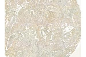 ABIN6259331 and ABIN6275349 at 1/100 staining human lung squamous cell carcinoma by IHC-P. (PEX14 antibody  (Internal Region))