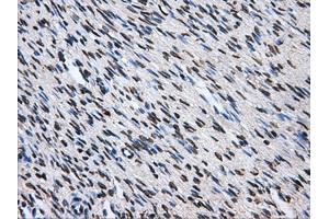 Immunohistochemical staining of paraffin-embedded Adenocarcinoma of colon tissue using anti-ATP5Bmouse monoclonal antibody. (ATP5B antibody)