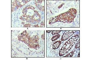 Immunohistochemical analysis of paraffin-embedded human breast carcinoma(A), lung cancer(B) and normal colon tissue(C), showing cytoplasmic localization with DAB staining using KRT19 mouse mAb. (Cytokeratin 19 antibody  (AA 80-400))