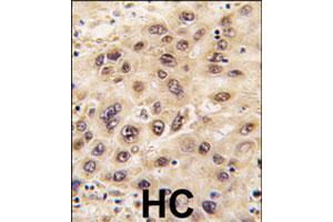 Formalin-fixed and paraffin-embedded human hepatocellular carcinoma reacted with GNL3 polyclonal antibody  , which was peroxidase-conjugated to the secondary antibody, followed by DAB staining. (Nucleostemin antibody  (AA 465-495))