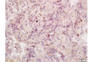Formalin-fixed and paraffin embedded human lung carcinoma labeled with Anti-RASSF1A Polyclonal Antibody, Unconjugated (ABIN673764) at 1:200 followed by conjugation to the secondary antibody and DAB staining. (RASSF1 antibody  (AA 145-260))