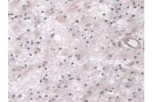 IHC-P analysis of Human Glioma Tissue, with DAB staining. (AHNAK antibody  (AA 1-300))