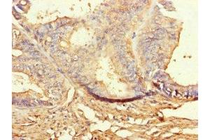 Immunohistochemistry of paraffin-embedded human endometrial cancer using ABIN7160080 at dilution of 1:100 (BUB1B antibody  (AA 230-394))