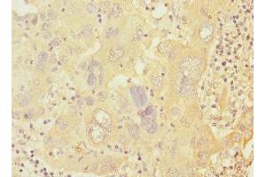 Immunohistochemistry of paraffin-embedded human liver cancer using ABIN7146619 at dilution of 1:100 (PRKAR1B antibody  (Regulatory Subunit))