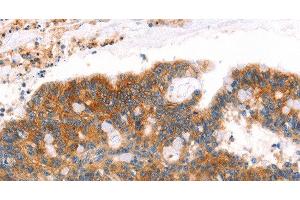 Immunohistochemistry of paraffin-embedded Human colon cancer tissue using AFDN Polyclonal Antibody at dilution 1:40 (Afadin antibody)
