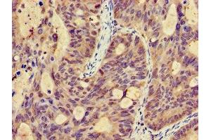 Immunohistochemistry of paraffin-embedded human colon cancer using ABIN7146326 at dilution of 1:100 (EFHA1 antibody  (AA 26-247))
